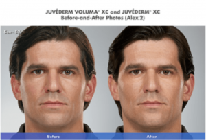 Juvederm Results