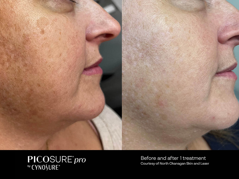 picosure