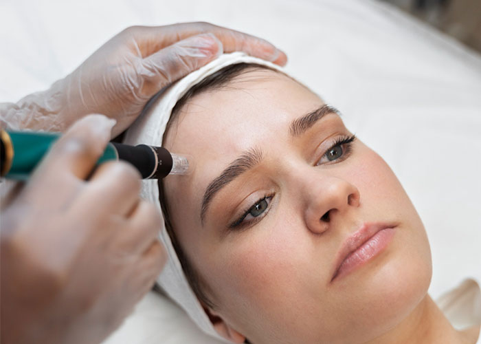 Potenza RF Microneedling Treatment