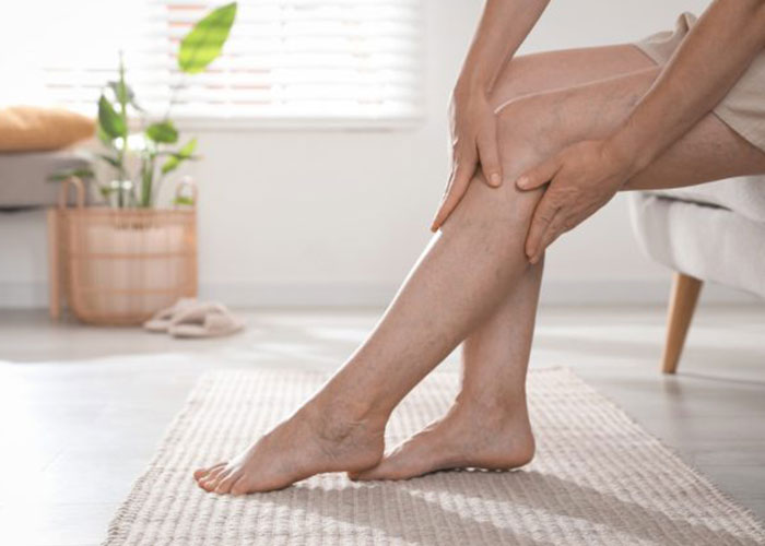 Varicose Vein Treatment in Redmond