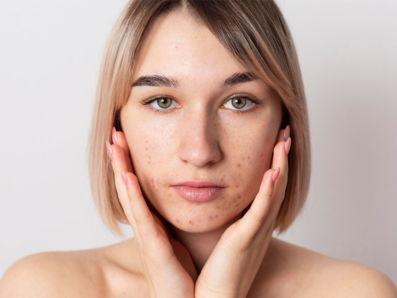 Acne and Scar Treatment in Redmond
