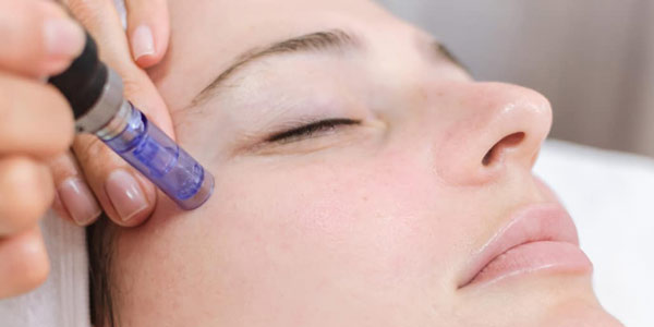 microneedling